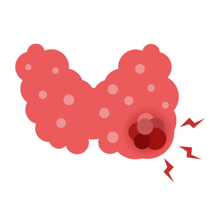 Read more about the article Guzki tarczycy – jakie są możliwości leczenia?