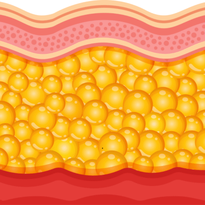 OFTT – czym jest doustny test tolerancji tłuszczów i kiedy warto go wykonać?